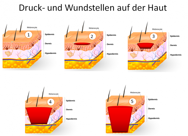 Der bauchschürze unter wund Rote, nässende